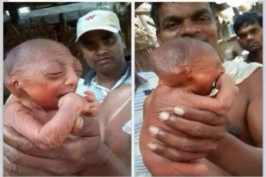 ولادة طفل عمره 110 والصحيح أنه يعاني الشيخوخة المبكرة ادعاء مضلل فتبينوا