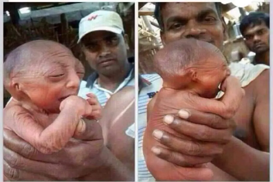 ولادة طفل عمره 110 والصحيح أنه يعاني الشيخوخة المبكرة ادعاء مضلل فتبينوا