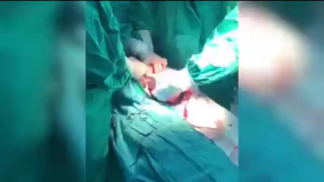 عملية قيصرية لأم مصابة بفيروس كورونا مضلل
