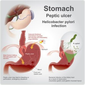 بكتيريا H.Pylori من العوامل الممرضة التي تزيد خطر حدوث القرحات وسرطان المعدة