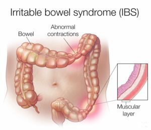 تشنج عضلات الأمعاء ومتلازمة القولون العصبي