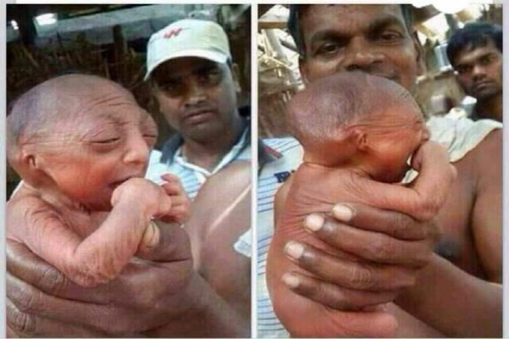 ولادة طفل عمره 110 والصحيح أنه يعاني الشيخوخة المبكرة ادعاء مضلل فتبينوا