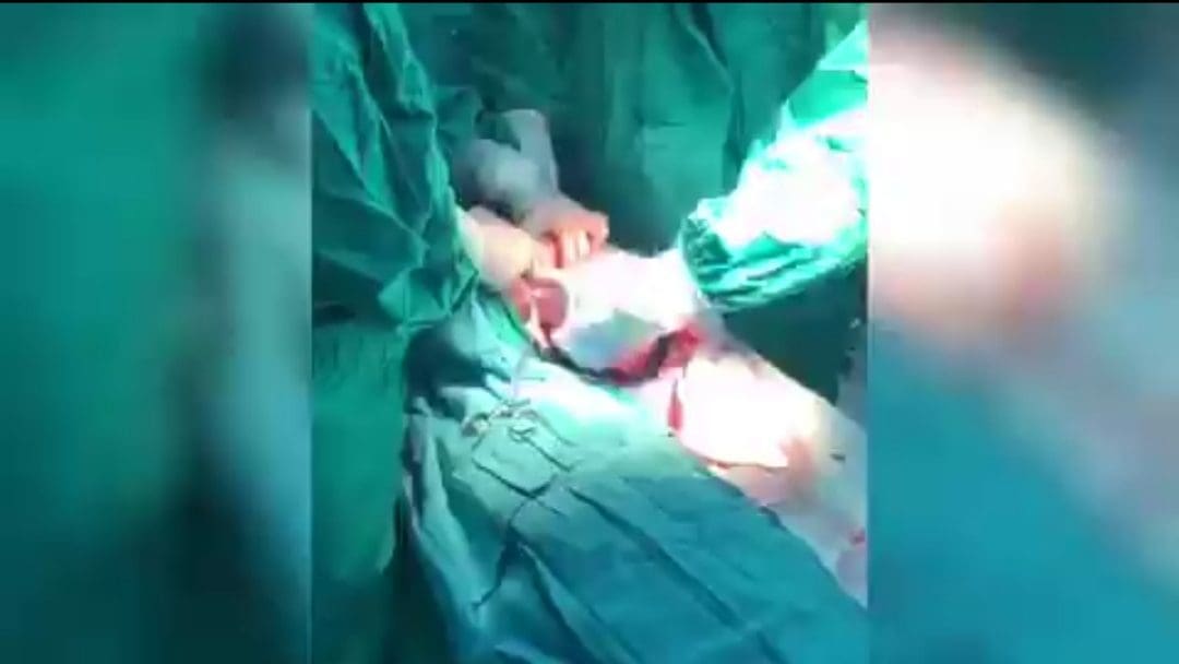 عملية قيصرية لأم مصابة بفيروس كورونا مضلل