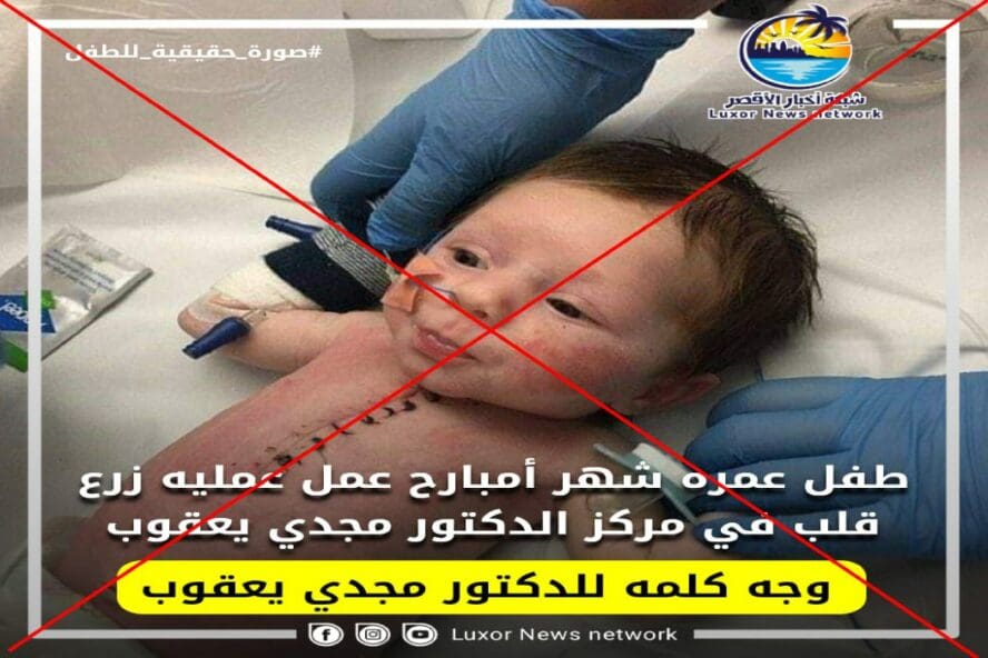 لم تجر عملية زرع القلب بل جراحة تصحيح عيوب خلقية