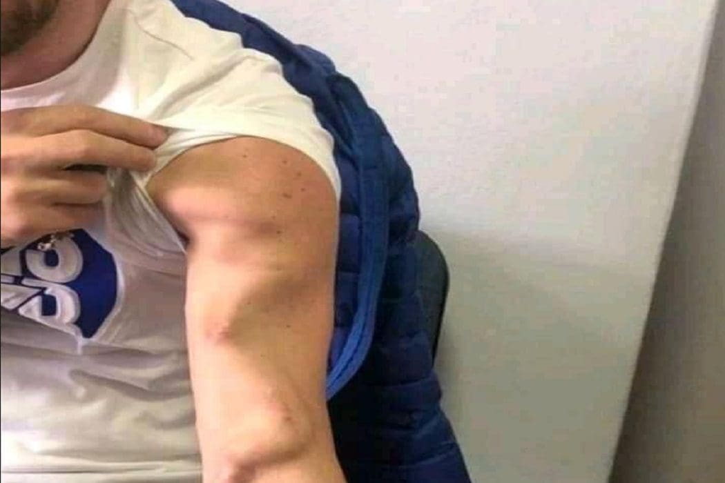 ادعاء ذراع شاب أخذ الجرعات الثلاث من لقاح كورونا مضلل فتبينوا